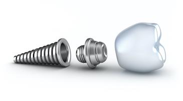3D rendering of dental implant | dental implants farmington hills mi
