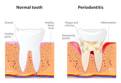 before & after gum disease 3D rendering | periodontal disease treatment farmington hills mi