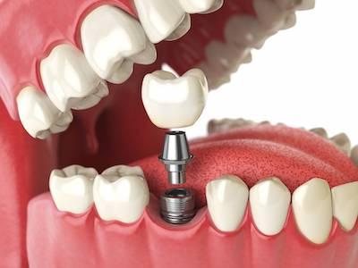 close up of dental implant in jaw | farmington hills mi dentist
