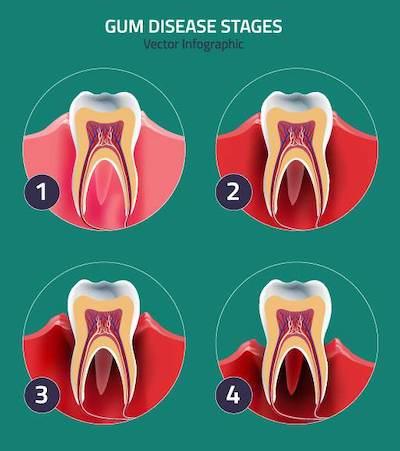 3D Rendering of Gum Disease | dentist farmington hills mi