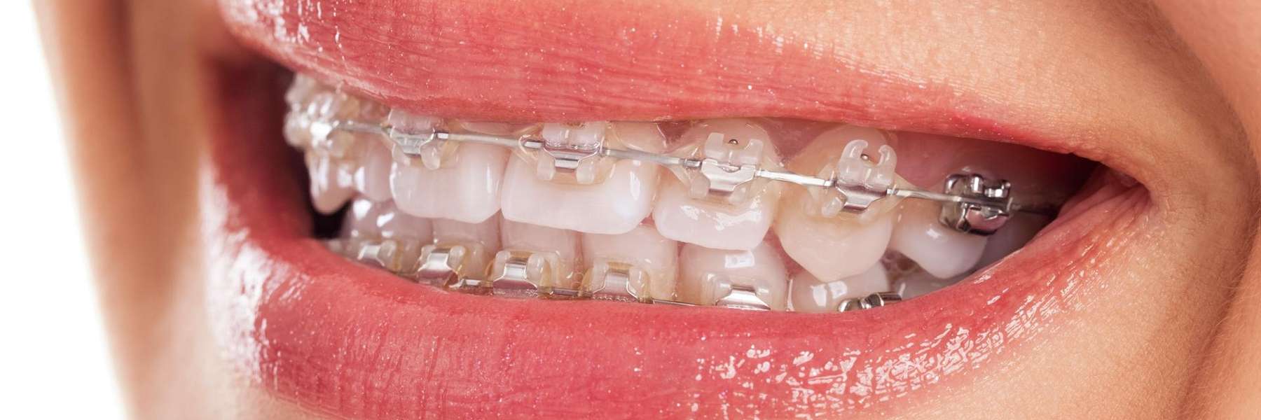 close up of traditional braces | farmington hills mi dentist