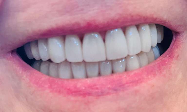 Cosmetic-Dentistry-After-Image