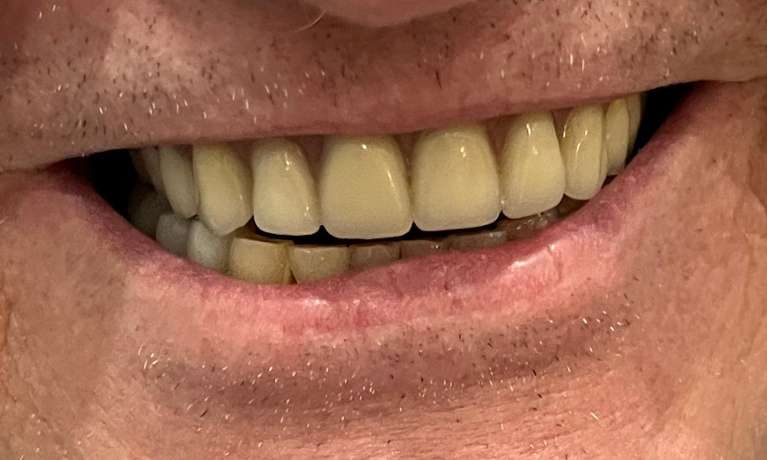 Full-Partial-Dentures-After-Image