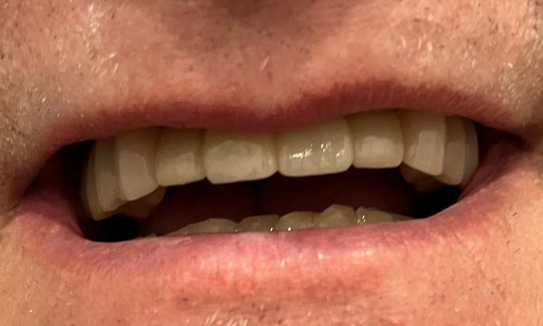 Implant-Bridge-After-Image
