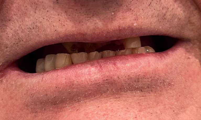 Full-Partial-Dentures-Before-Image
