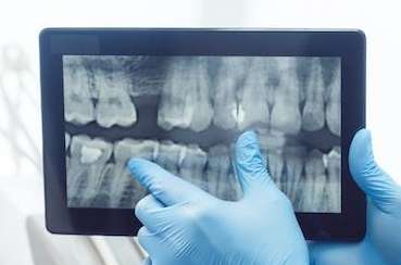 close up of digital x-ray | dentist farmington hills mi