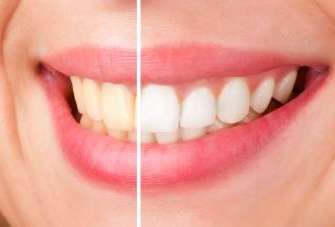 before and after teeth whitening | teeth whitening farmington hills mi